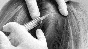 mésothérapie cheveux clinique Crillon Lyon