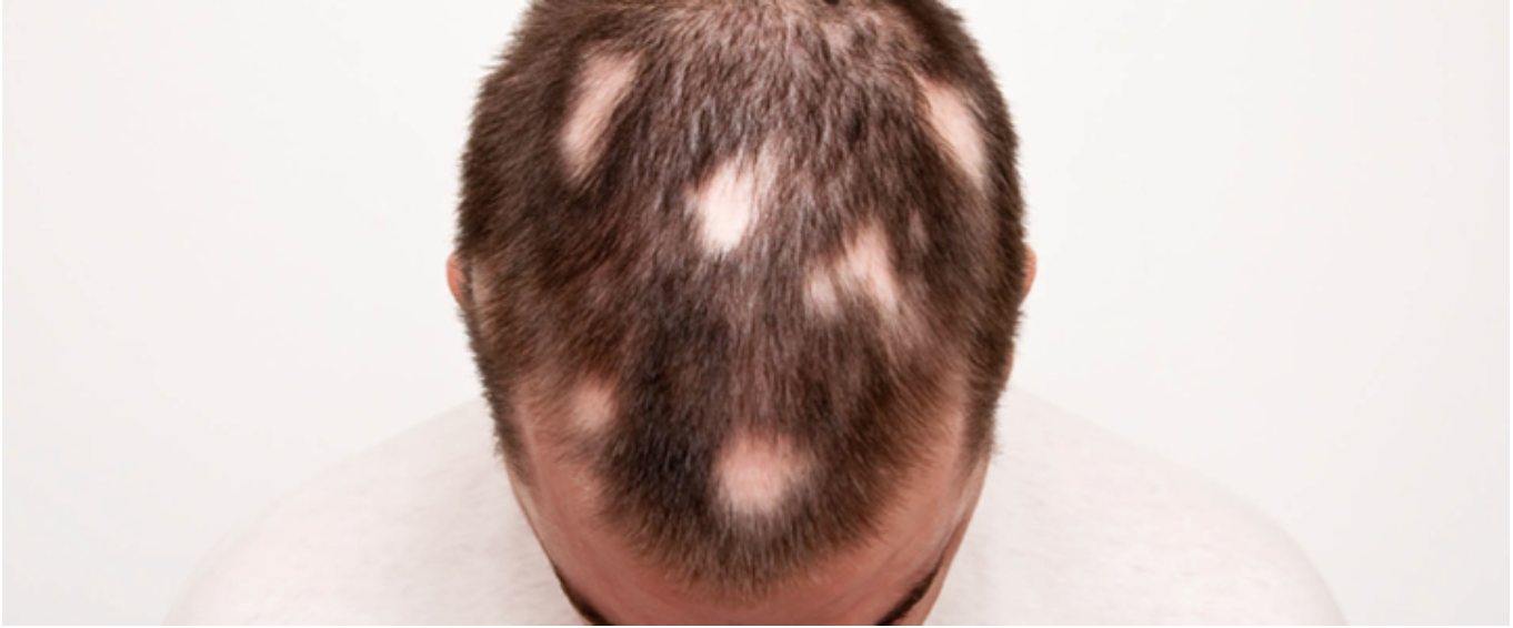 traitement pelade cheveux lyon