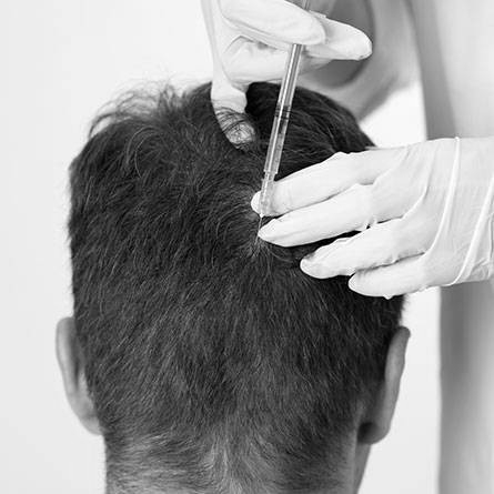 mesogreffe Lyon clinique crillon alopecie chute de cheveux