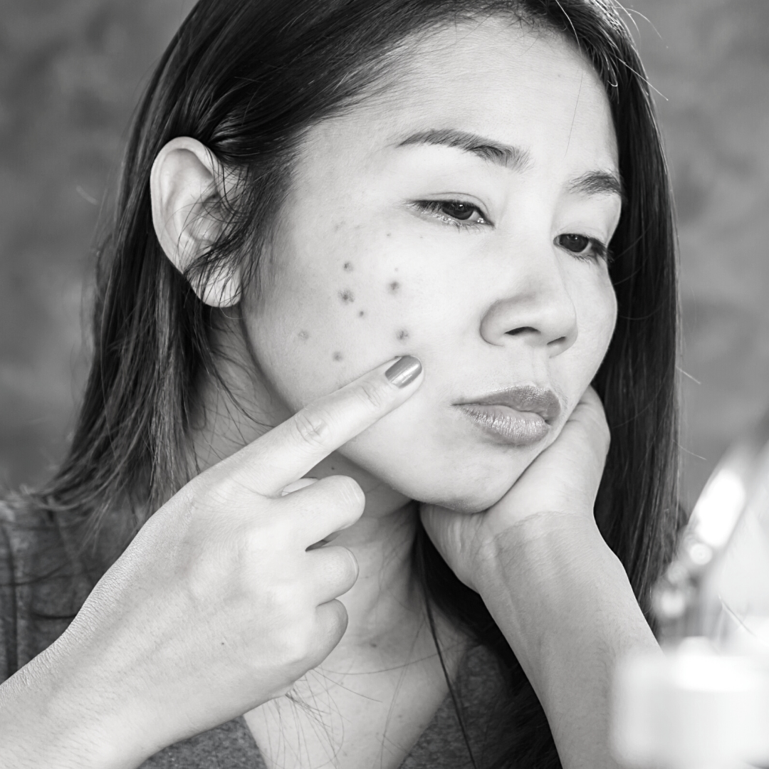 Taches pigmentaires et cicatrices d'acné : comment les traiter grâce au laser ?
