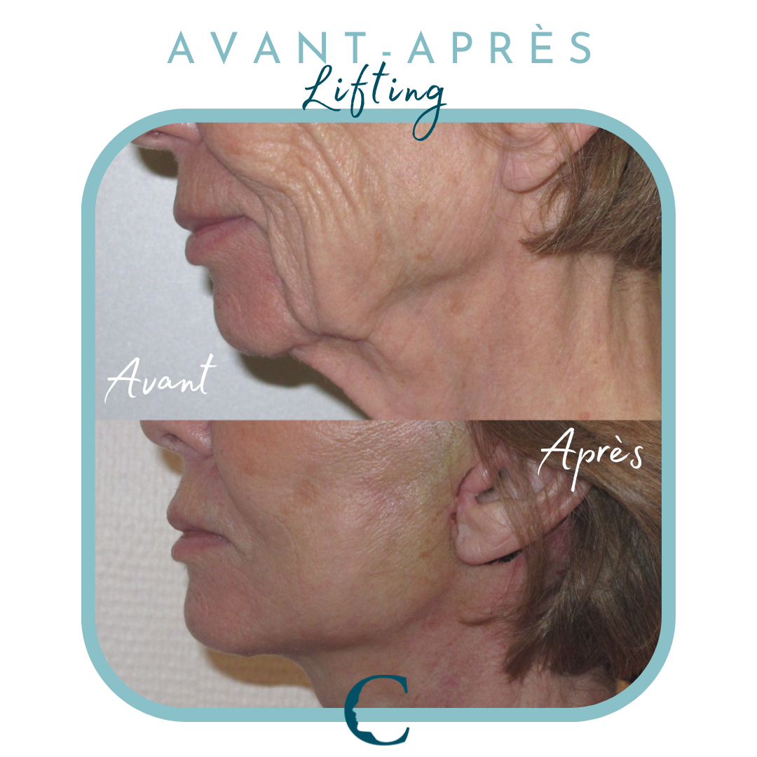 Chirurgie visage Lyon 