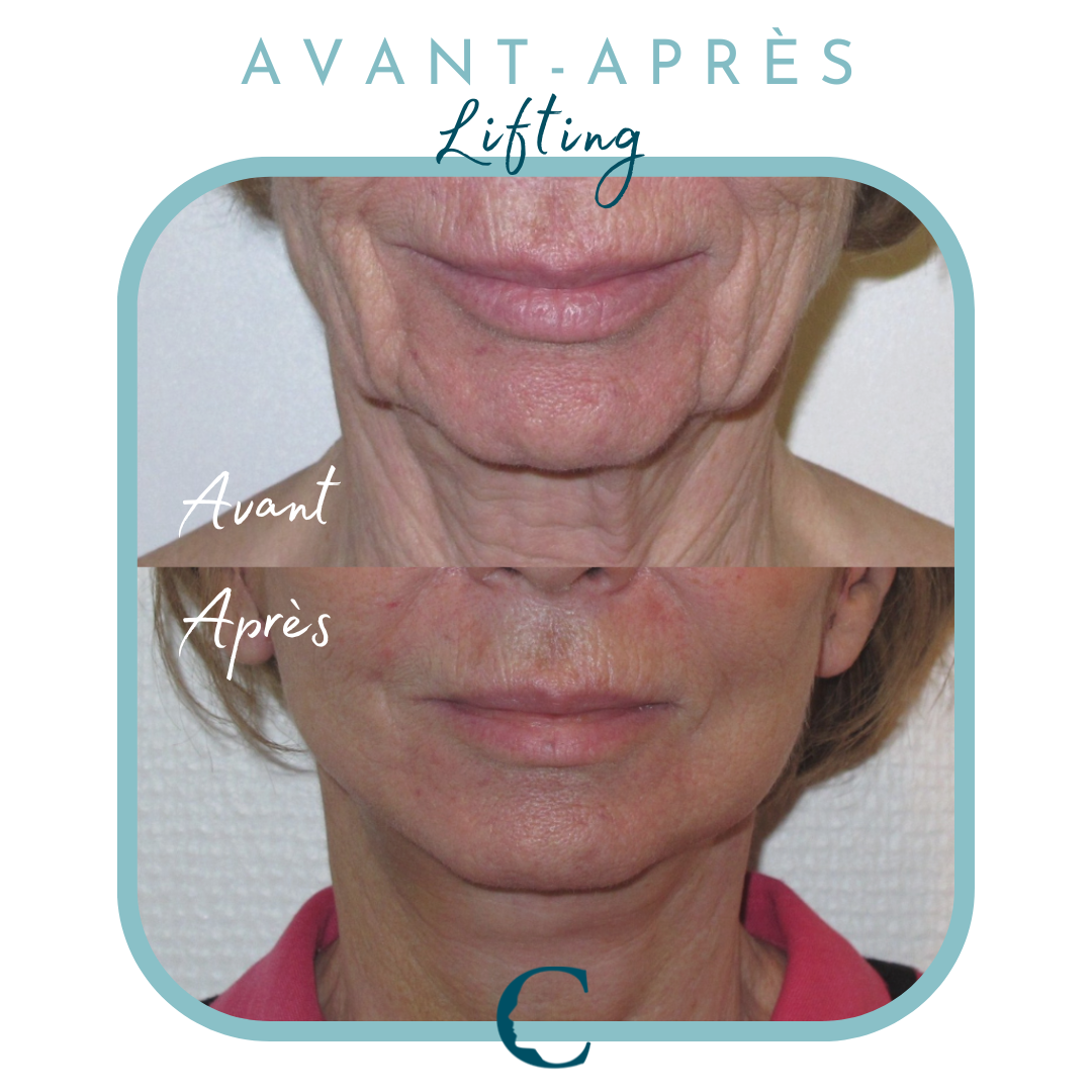 Chirurgie visage Lyon 