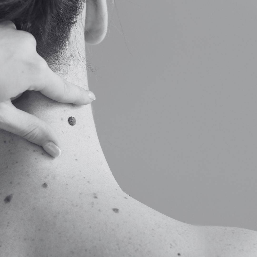 L'ablation de grains de beauté 