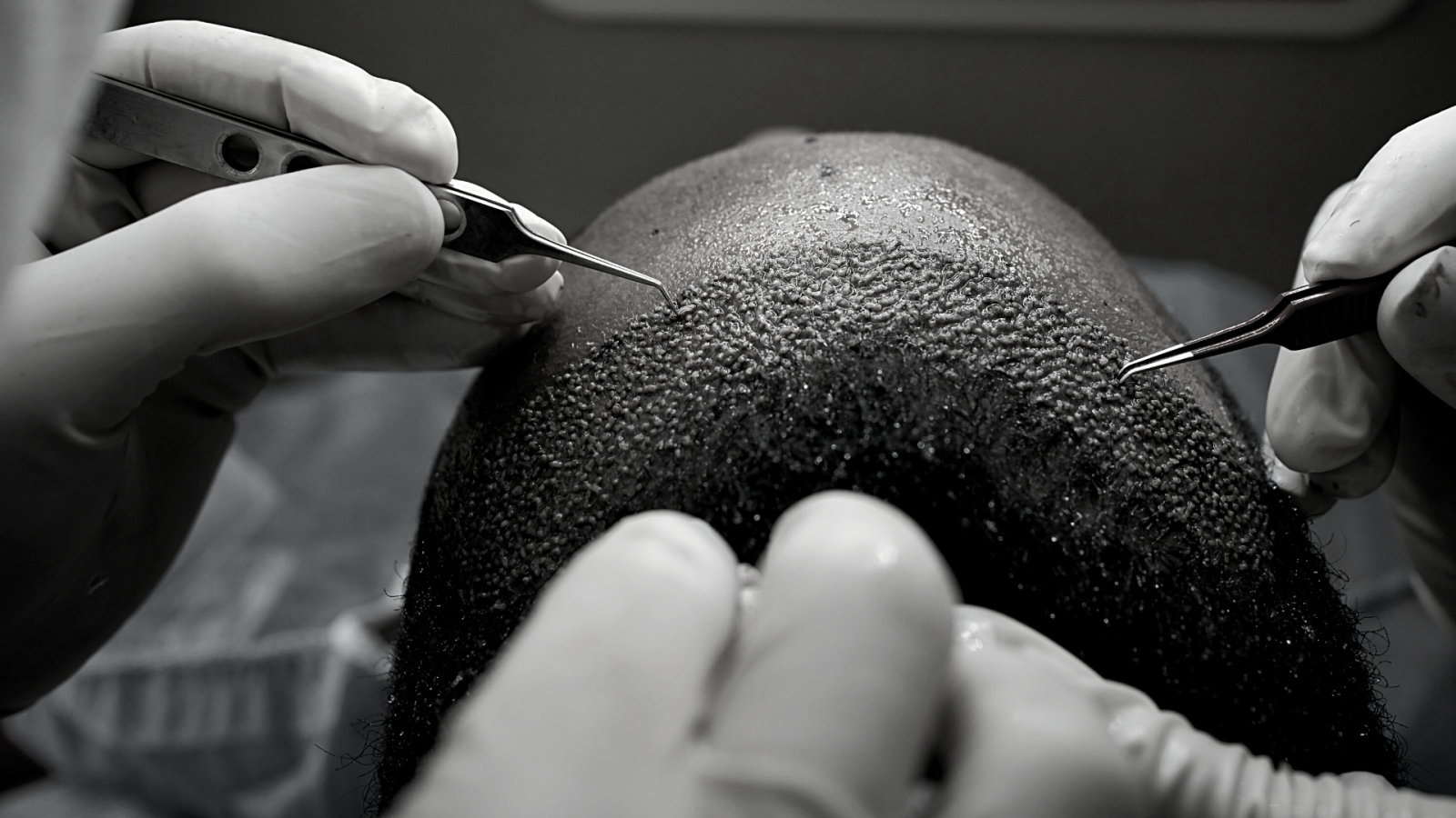 greffe capillaire Lyon