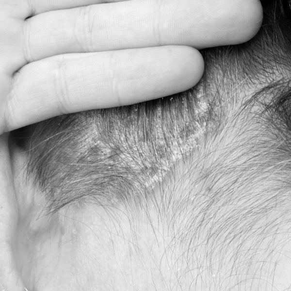 Traiter le Psoriasis 